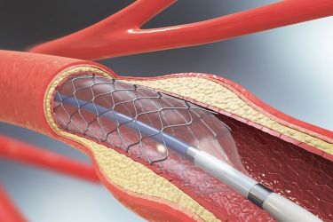 Angioplasty Heart Stent Hero