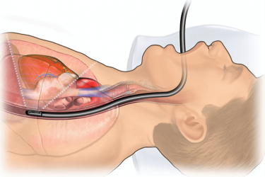 Trans Oesophageal Echocardiogram Illustration Da8Ade