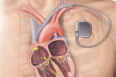Inserting A Pacemaker 9Ec40B